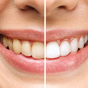 How to get rid of discolored and yellow teeth